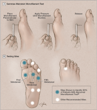 Pédicure et podologie des patients diabétiques ( grade 0 au grade 3)